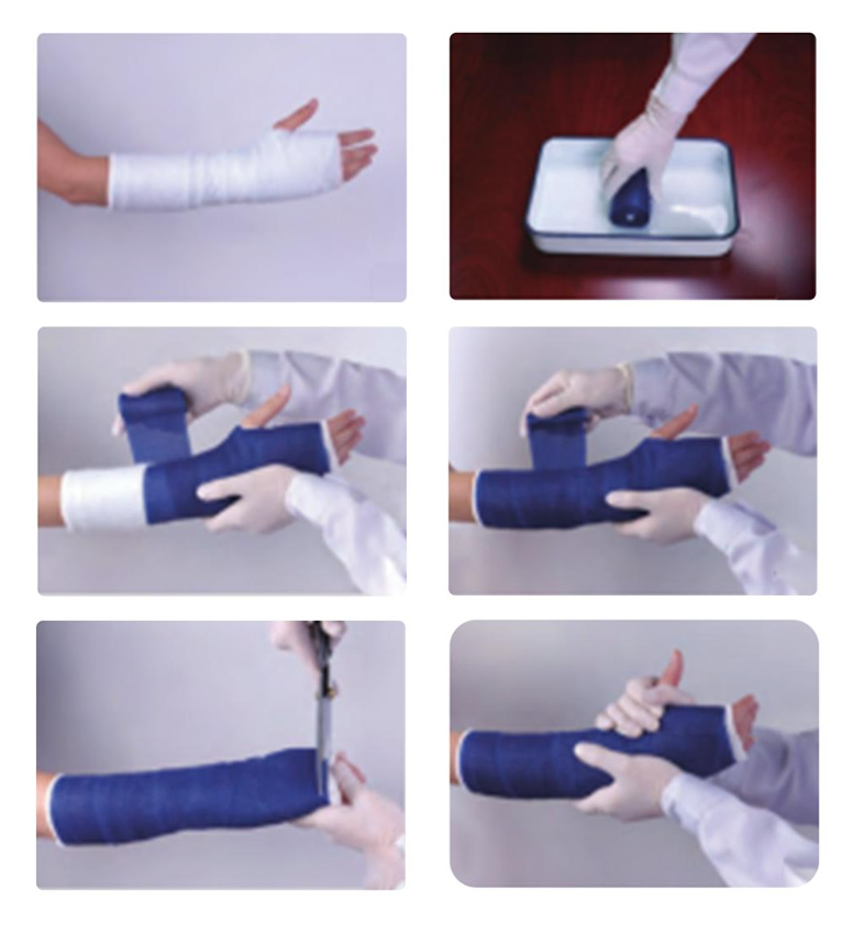 ຂັ້ນ​ຕອນ​ໃນ​ການ​ນໍາ​ໃຊ້ Orthopedic Casting Tape